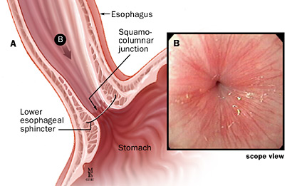 Restoration of Esophageal Mucosa