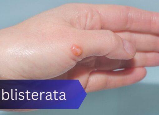 Blisterata: Understanding and Managing Skin Blisters